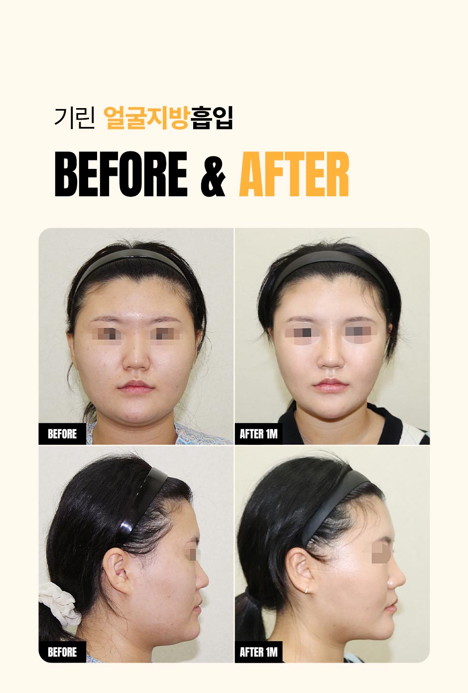 얼굴지방흡입_미인하이_03.jpg