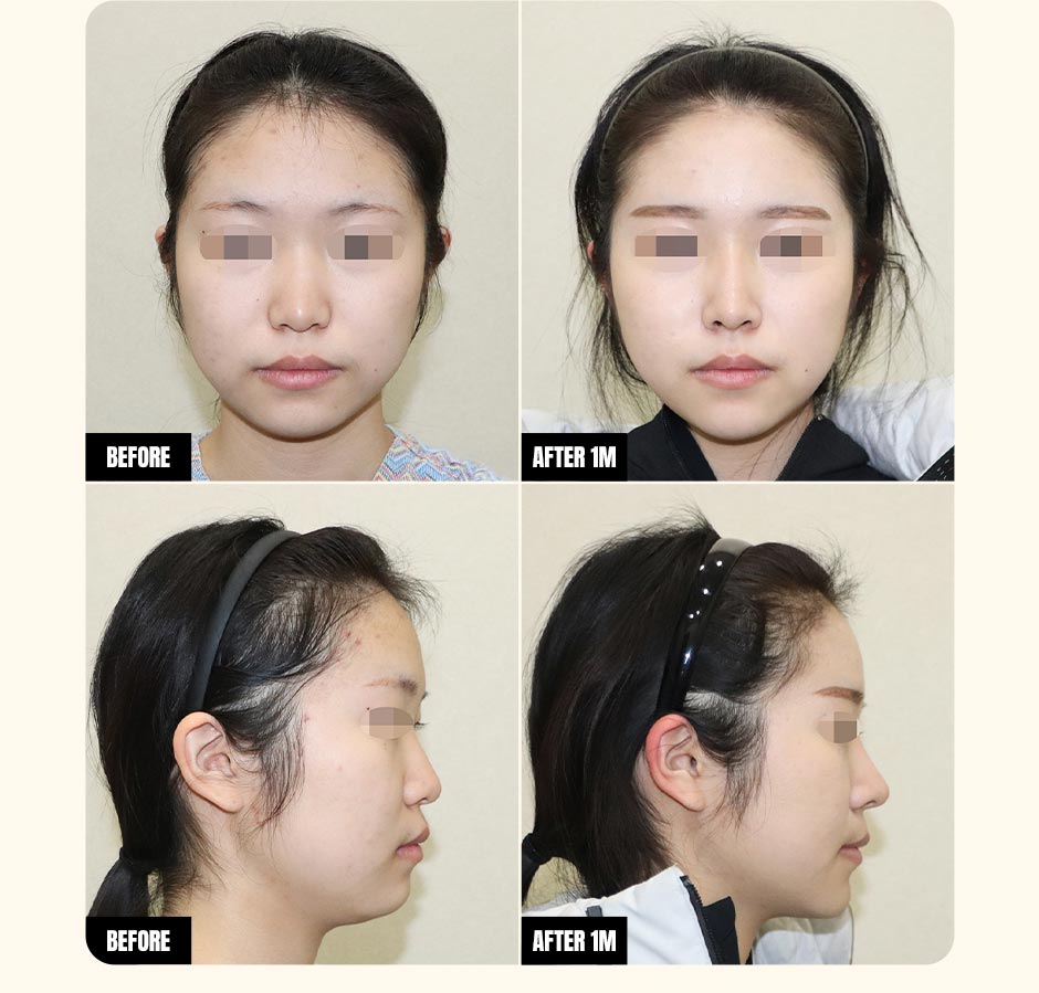 얼굴지방흡입_미인하이_04.jpg