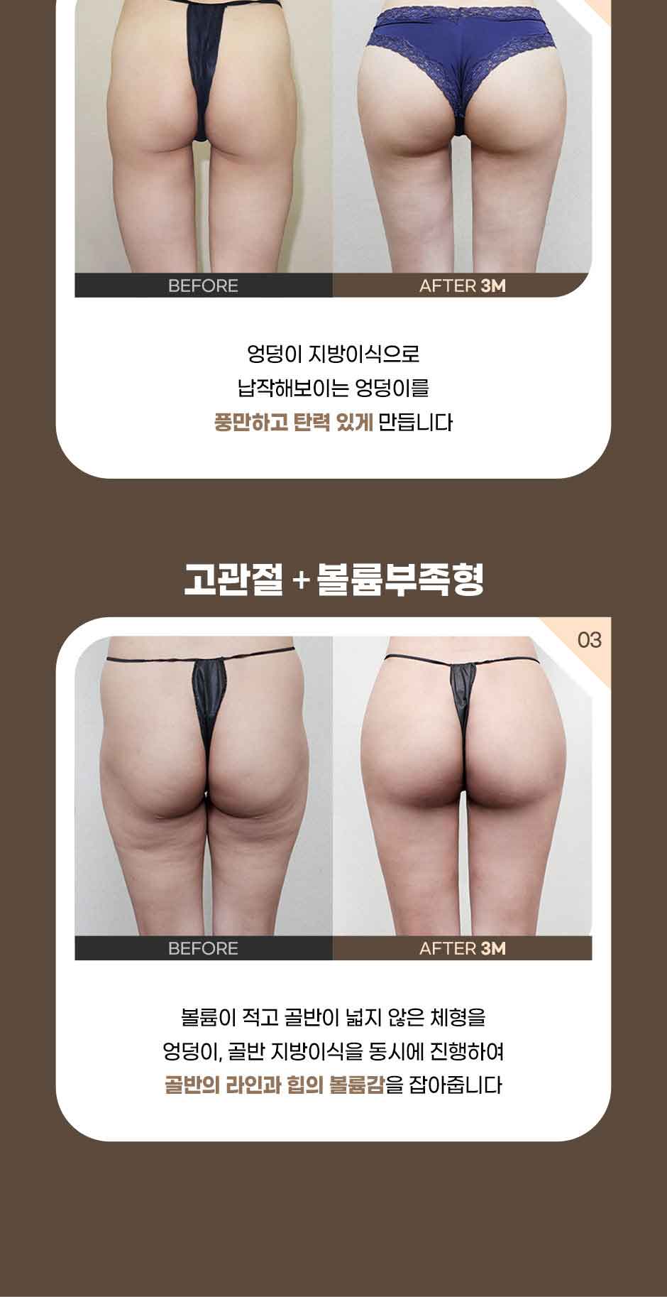 엉덩이지방이식_미인하이_05.jpg