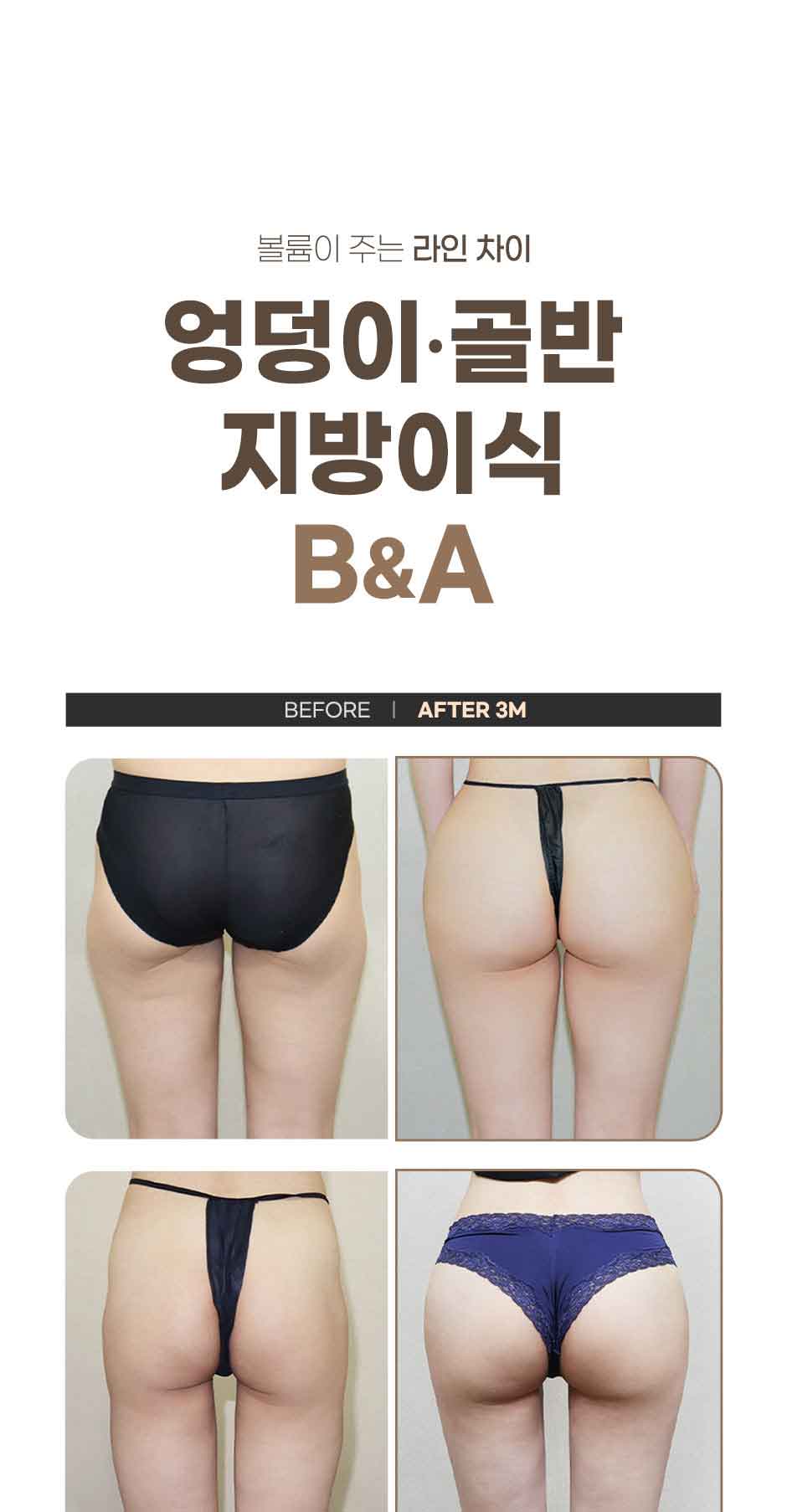 엉덩이지방이식_미인하이_06.jpg