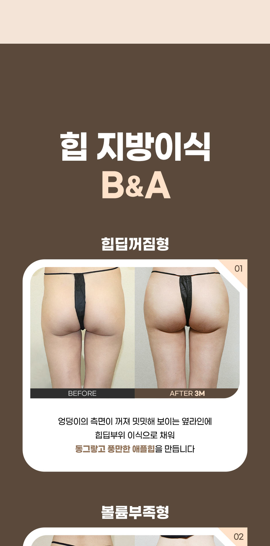 엉덩이지방이식_미인하이_04.jpg