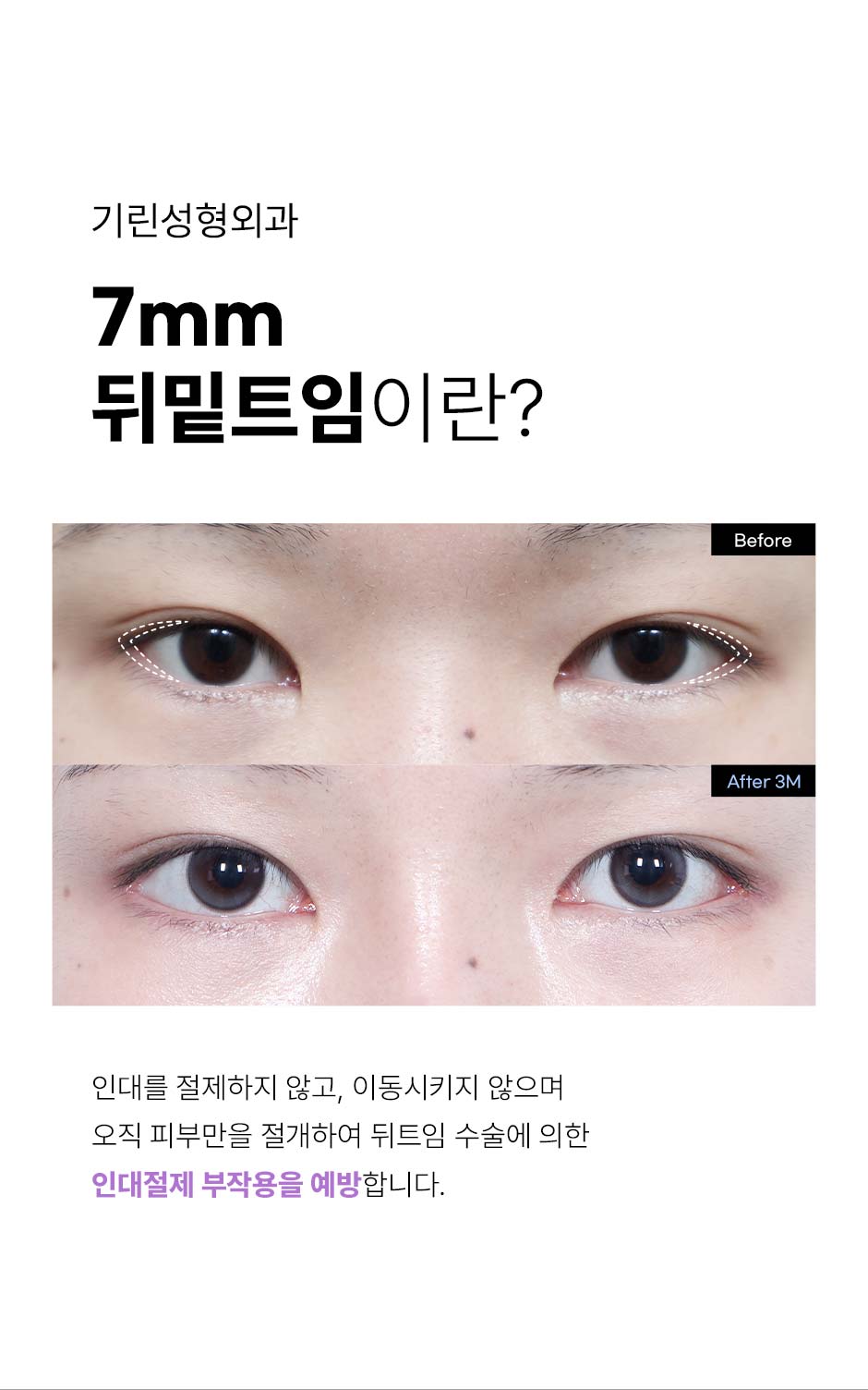 7mm뒤밑트임_02.jpg