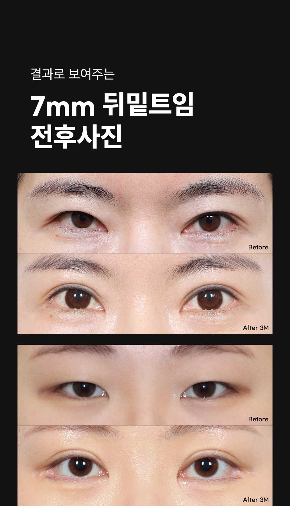 7mm뒤밑트임_03.jpg