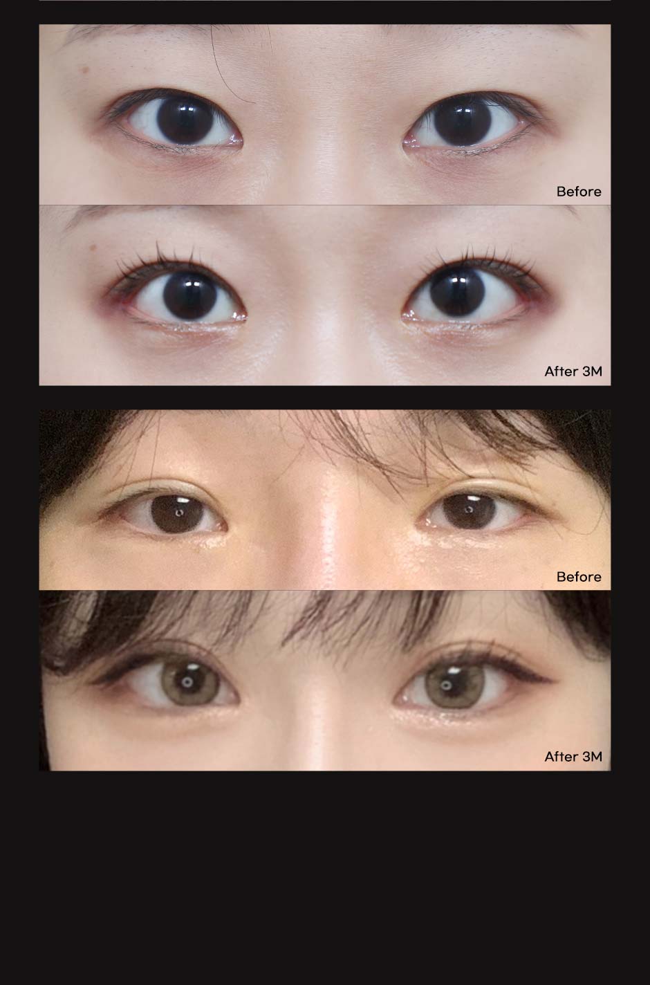 7mm뒤밑트임_05.jpg