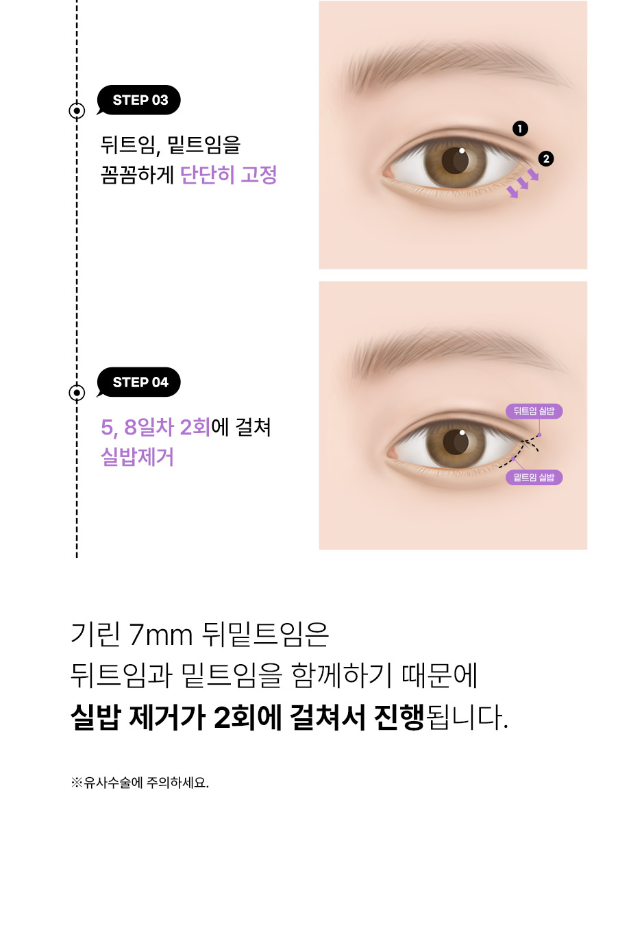 7mm뒤밑트임_07.jpg