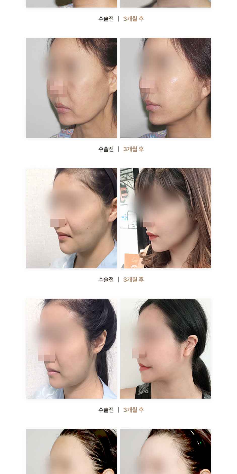 연조직윤곽술_미인하이_08.jpg