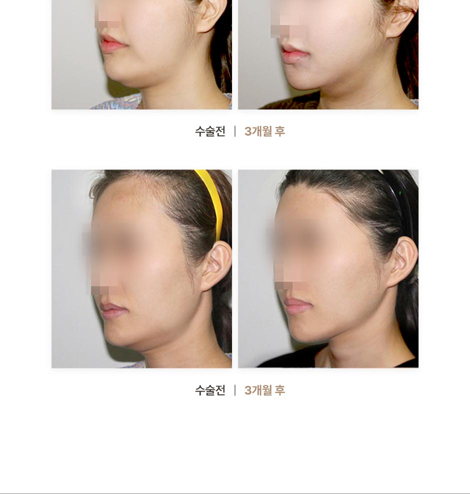 연조직윤곽술_미인하이_09.jpg