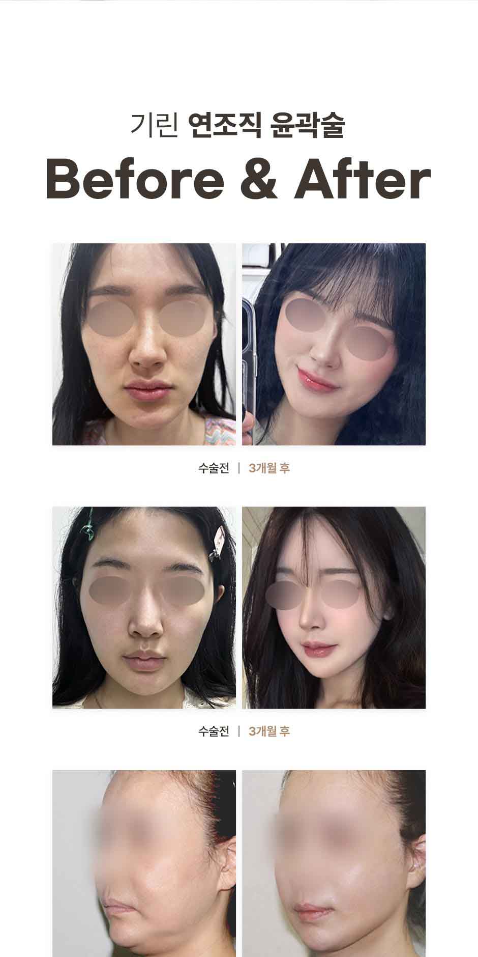 연조직윤곽술_미인하이_07.jpg