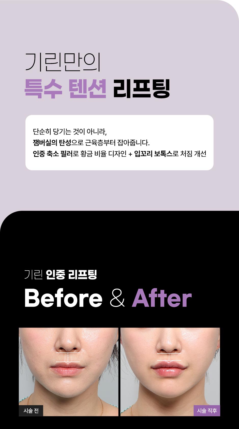 인중리프팅_미인하이_04.jpg