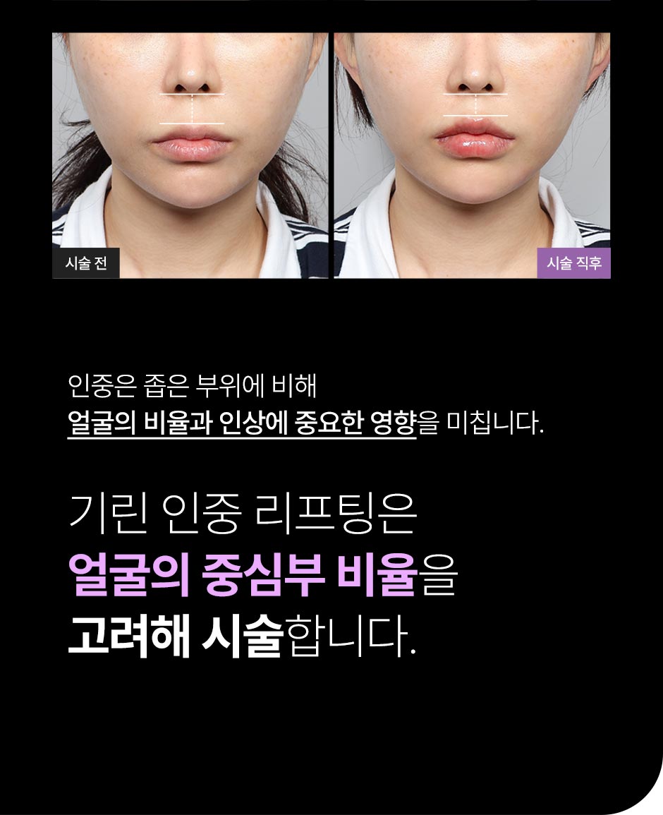 인중리프팅_미인하이_06.jpg