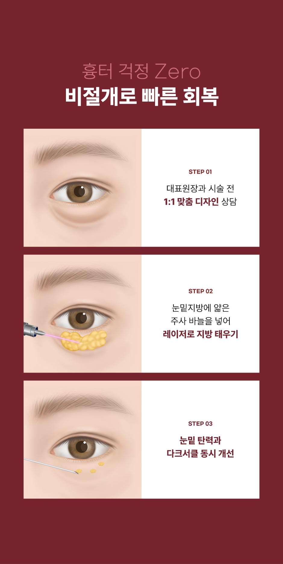 비절개눈밑지_미인하이_05.jpg