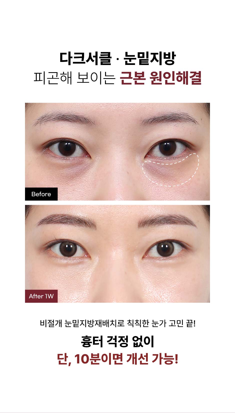 비절개눈밑지_미인하이_04.jpg