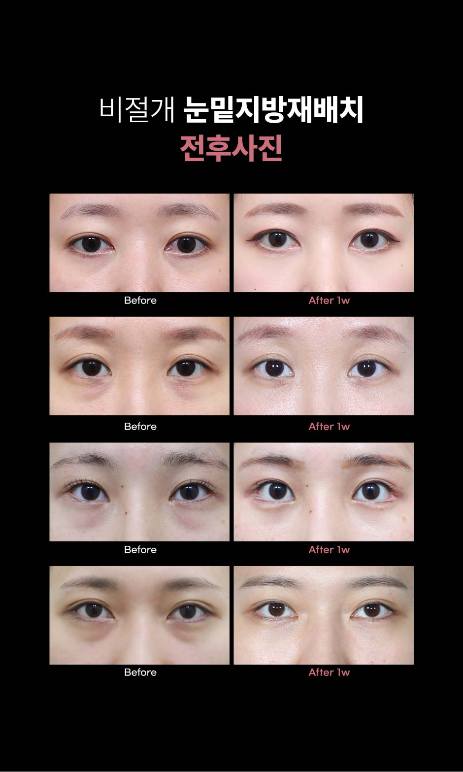 비절개눈밑지_미인하이_09.jpg