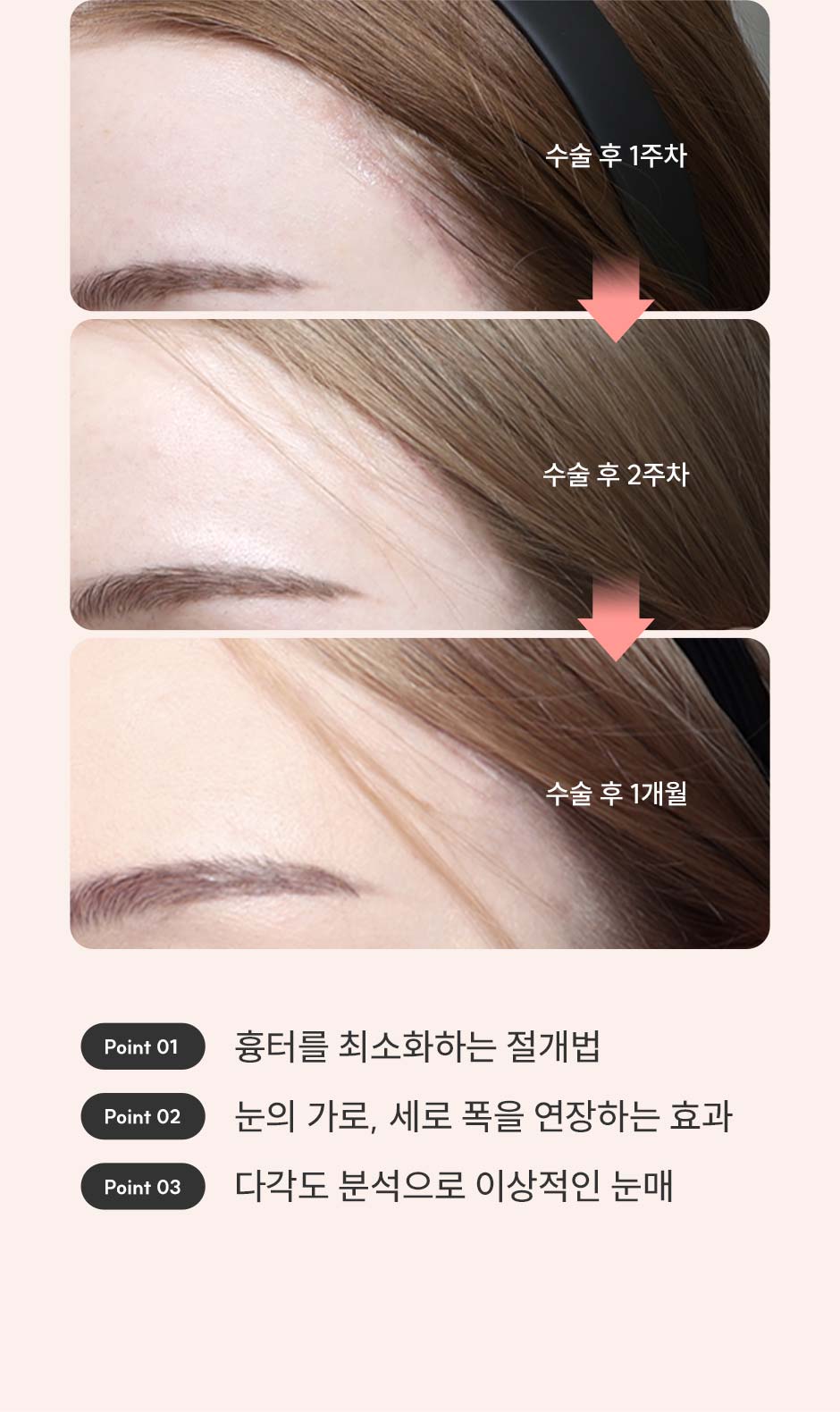 눈빛리프팅_미인하이_08.jpg