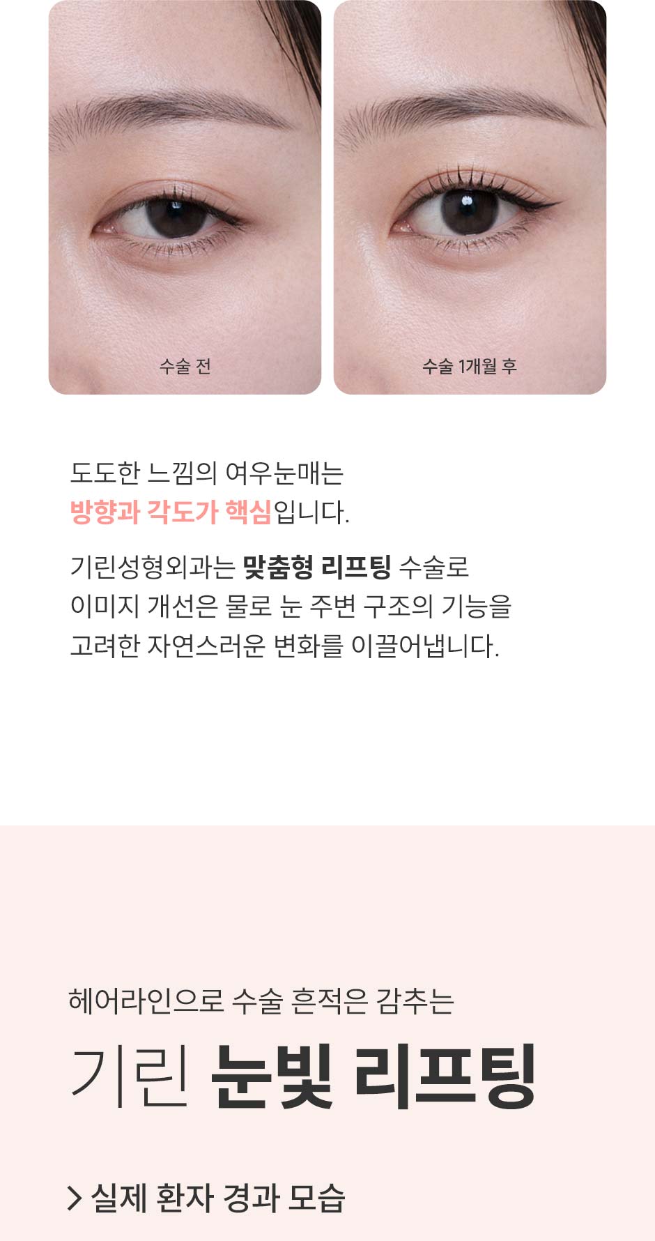 눈빛리프팅_미인하이_07.jpg