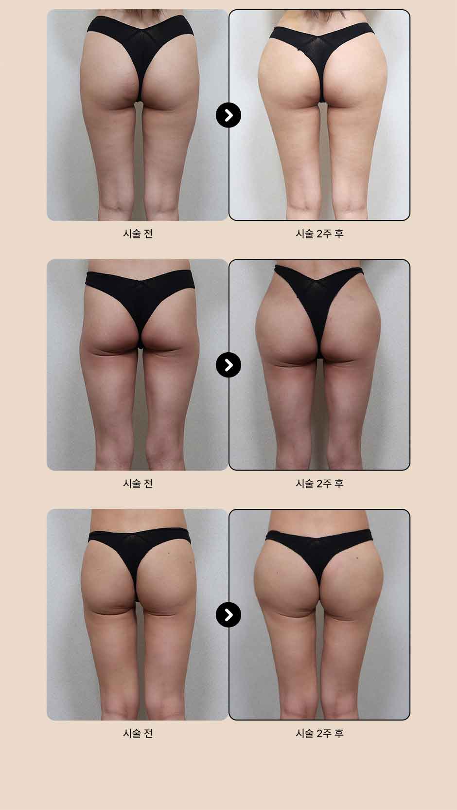 바디필러_미인하이_05.jpg