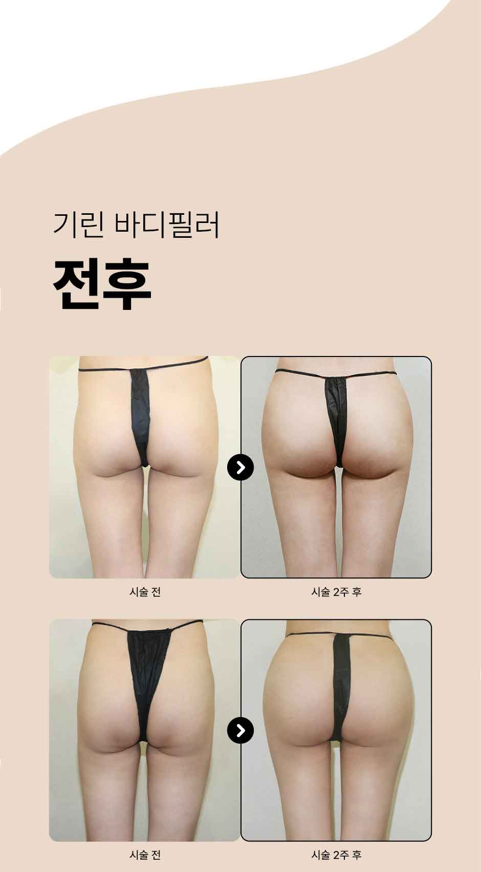 바디필러_미인하이_04.jpg