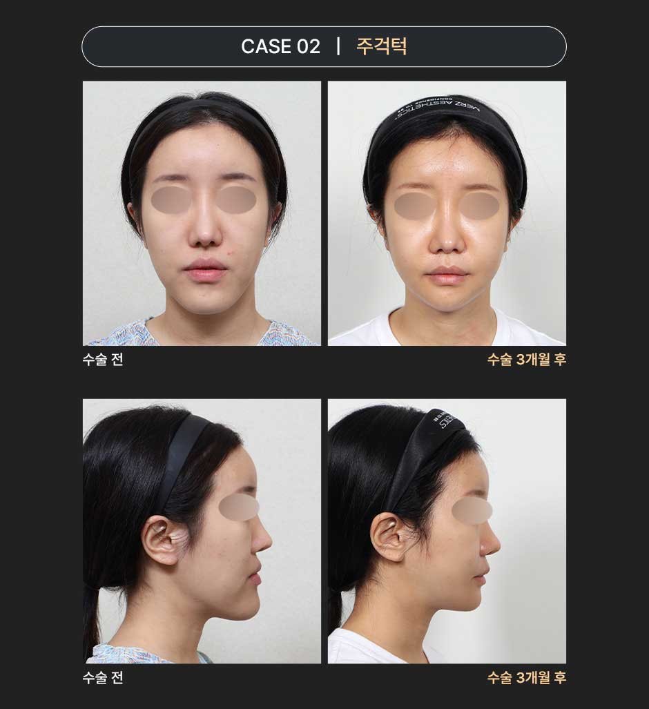 밀착양악_미인하이_04.jpg