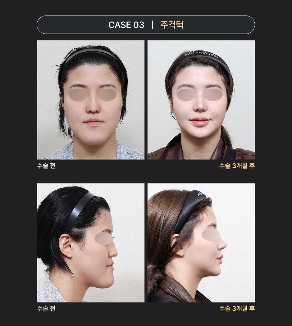 밀착양악_미인하이_05.jpg