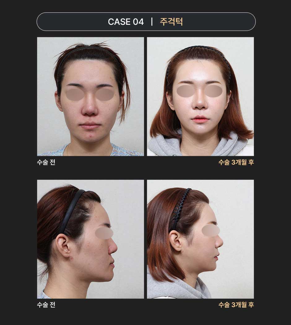 밀착양악_미인하이_06.jpg