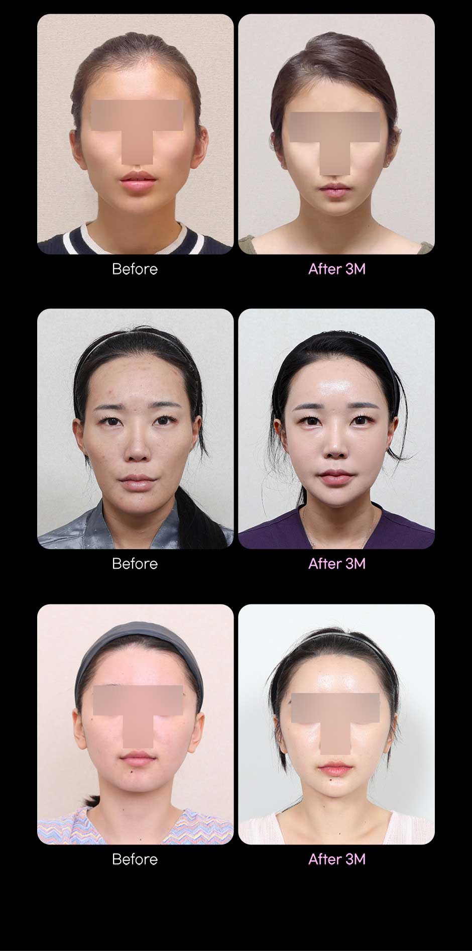 뉴V라인_미인하이_05.jpg