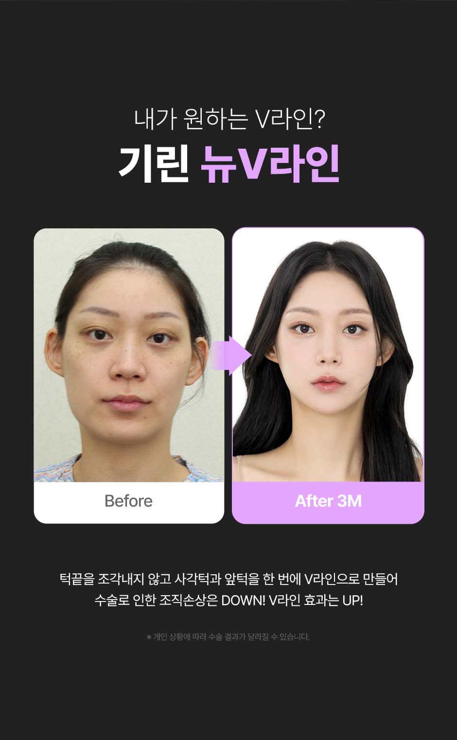 뉴V라인_미인하이_02.jpg