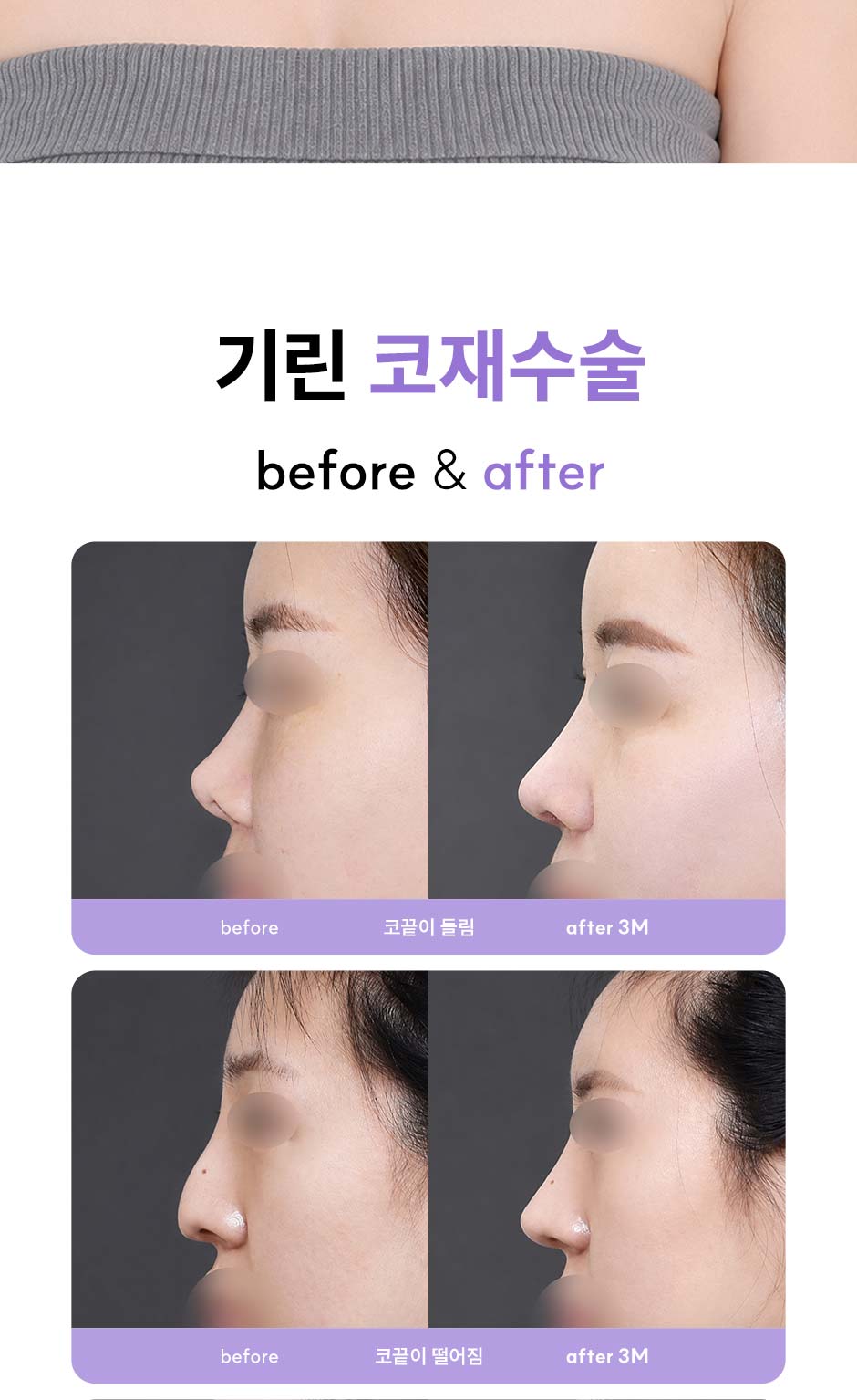 코재수술_미인하이_03.jpg