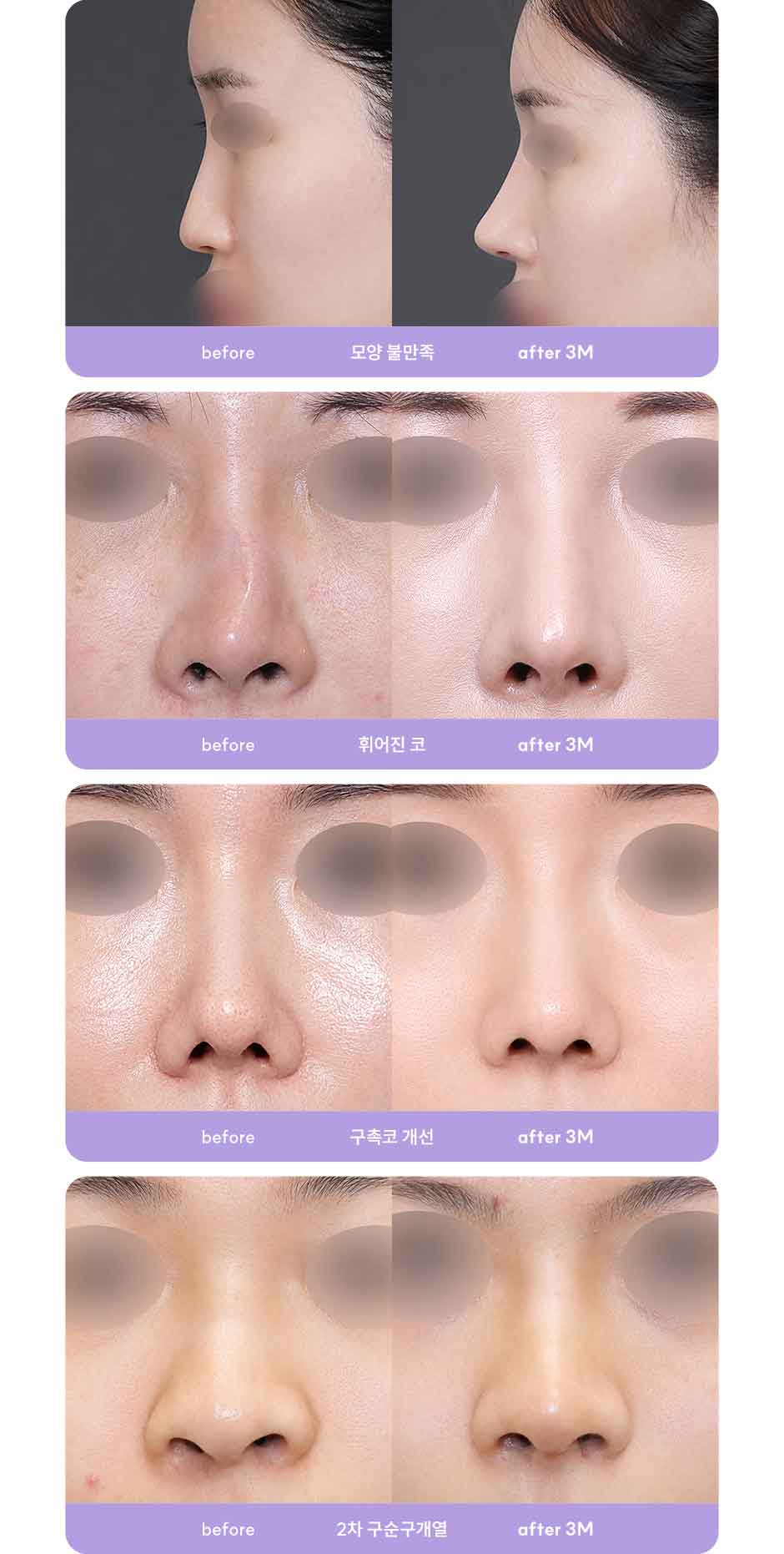 코재수술_미인하이_04.jpg