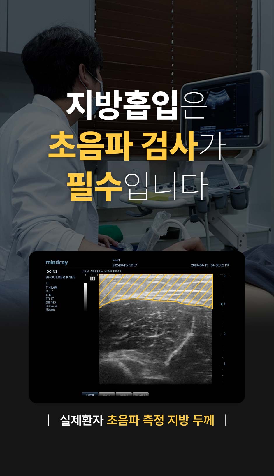 초음파뼈벅지지흡_03.jpg