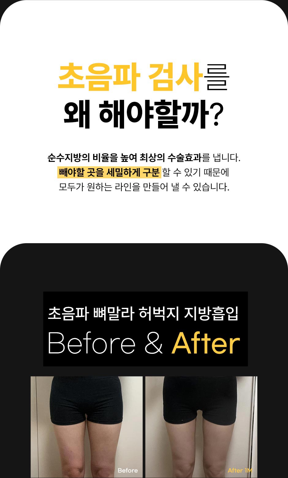초음파뼈벅지지흡_04.jpg