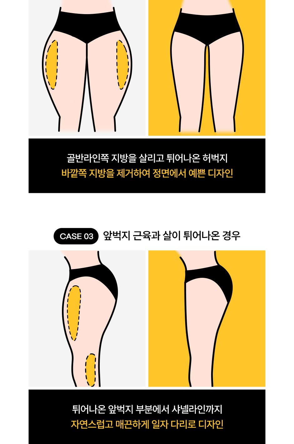 초음파뼈벅지지흡_08.jpg