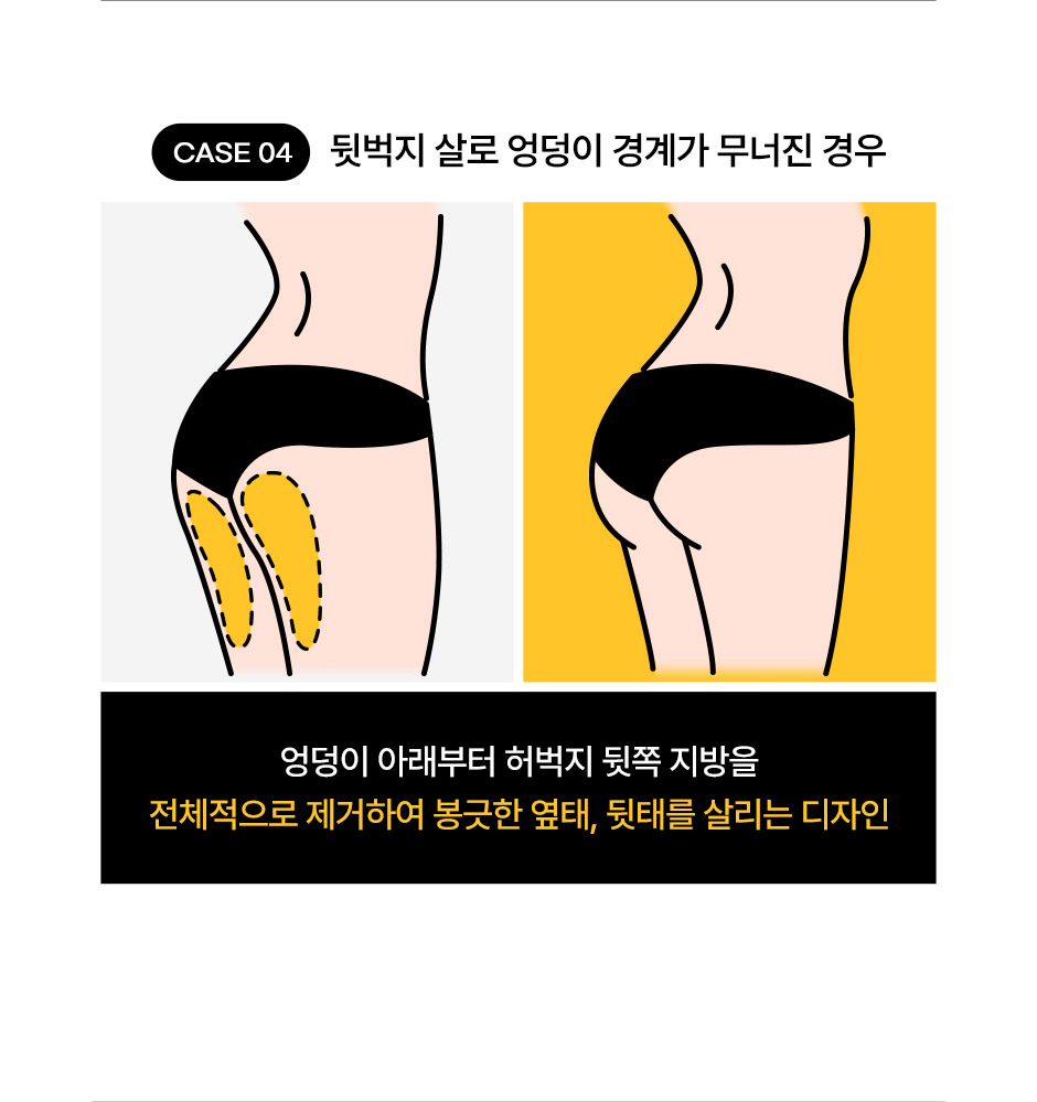 초음파뼈벅지지흡_09.jpg