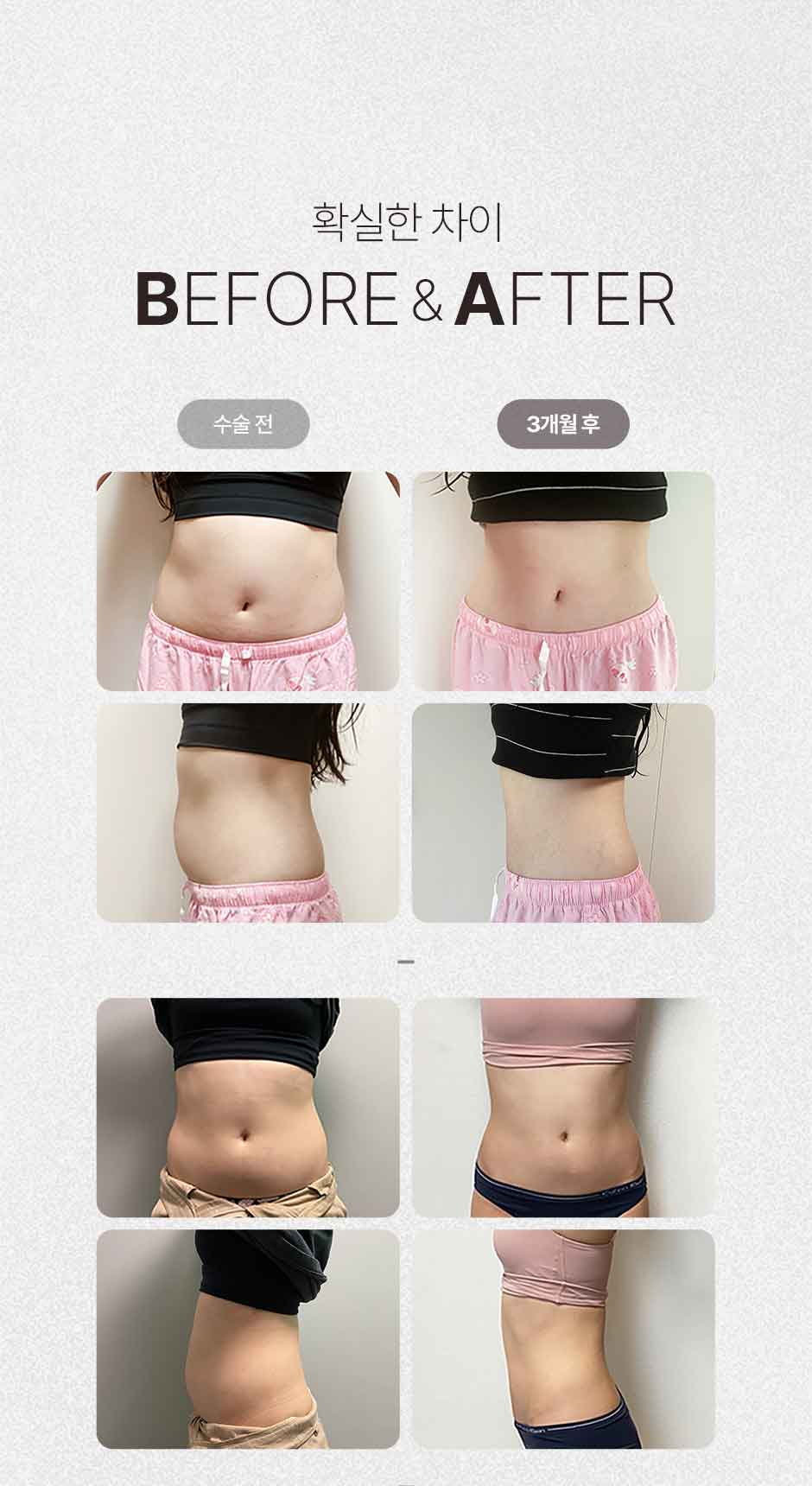 복부전체지방흡입_미인하이_06.jpg
