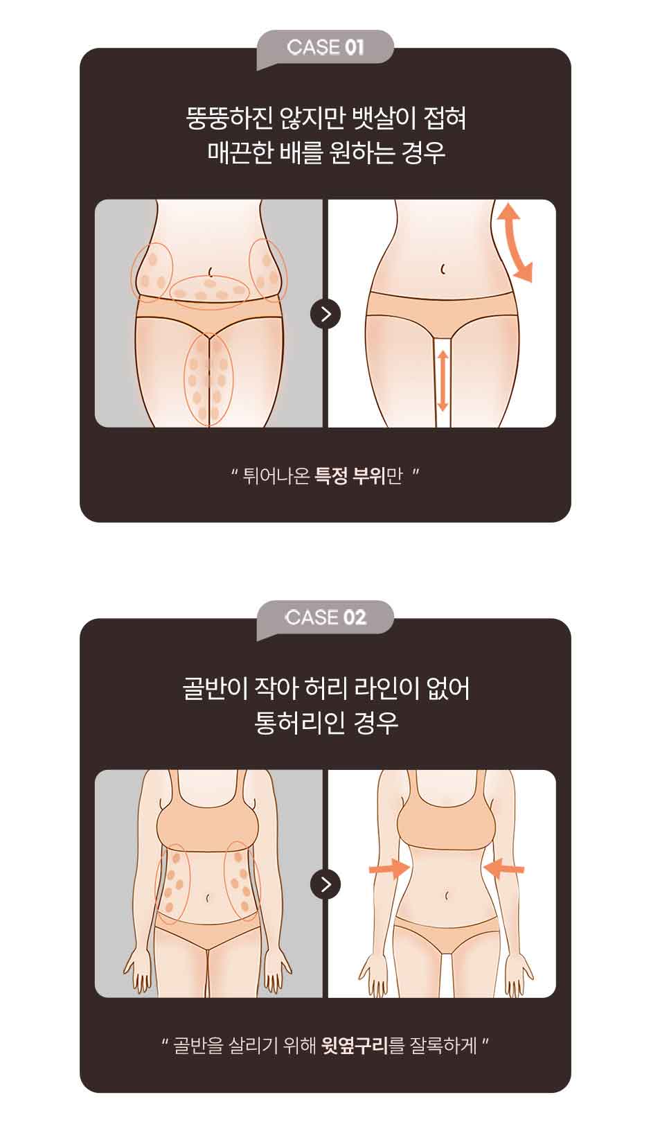 복부전체지방흡입_미인하이_10.jpg