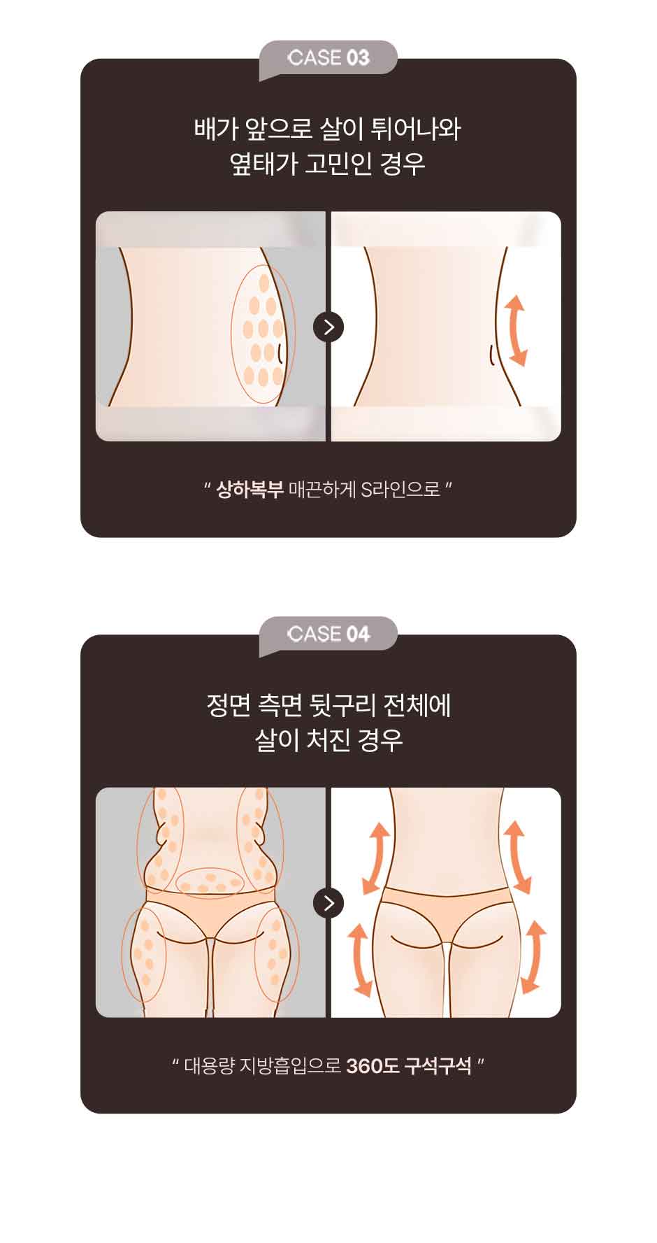 복부전체지방흡입_미인하이_11.jpg