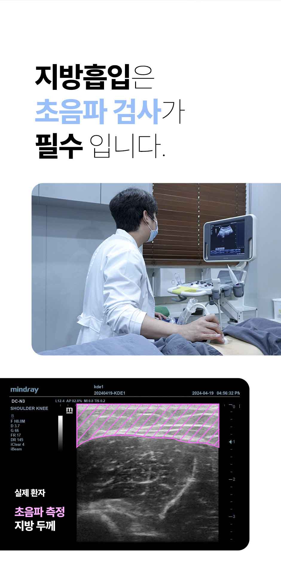 뼈말라팔뚝지방흡입_미인하이_03.jpg
