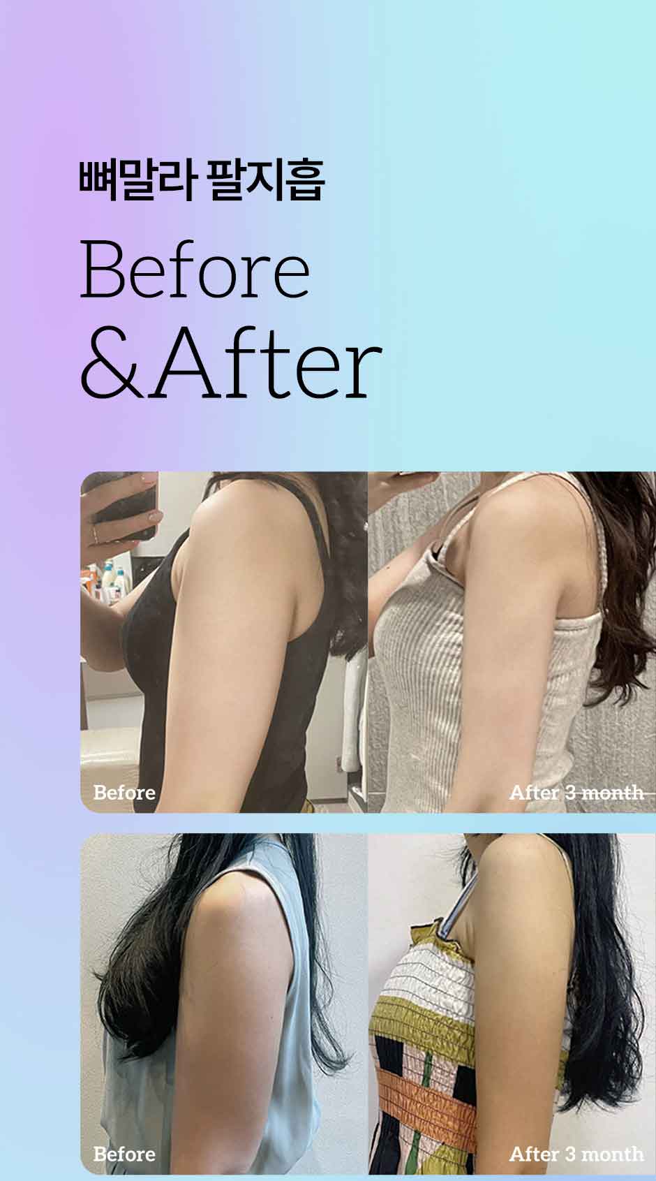 뼈말라팔뚝지방흡입_미인하이_05.jpg