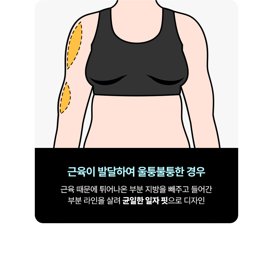 뼈말라팔뚝지방흡입_미인하이_12.jpg