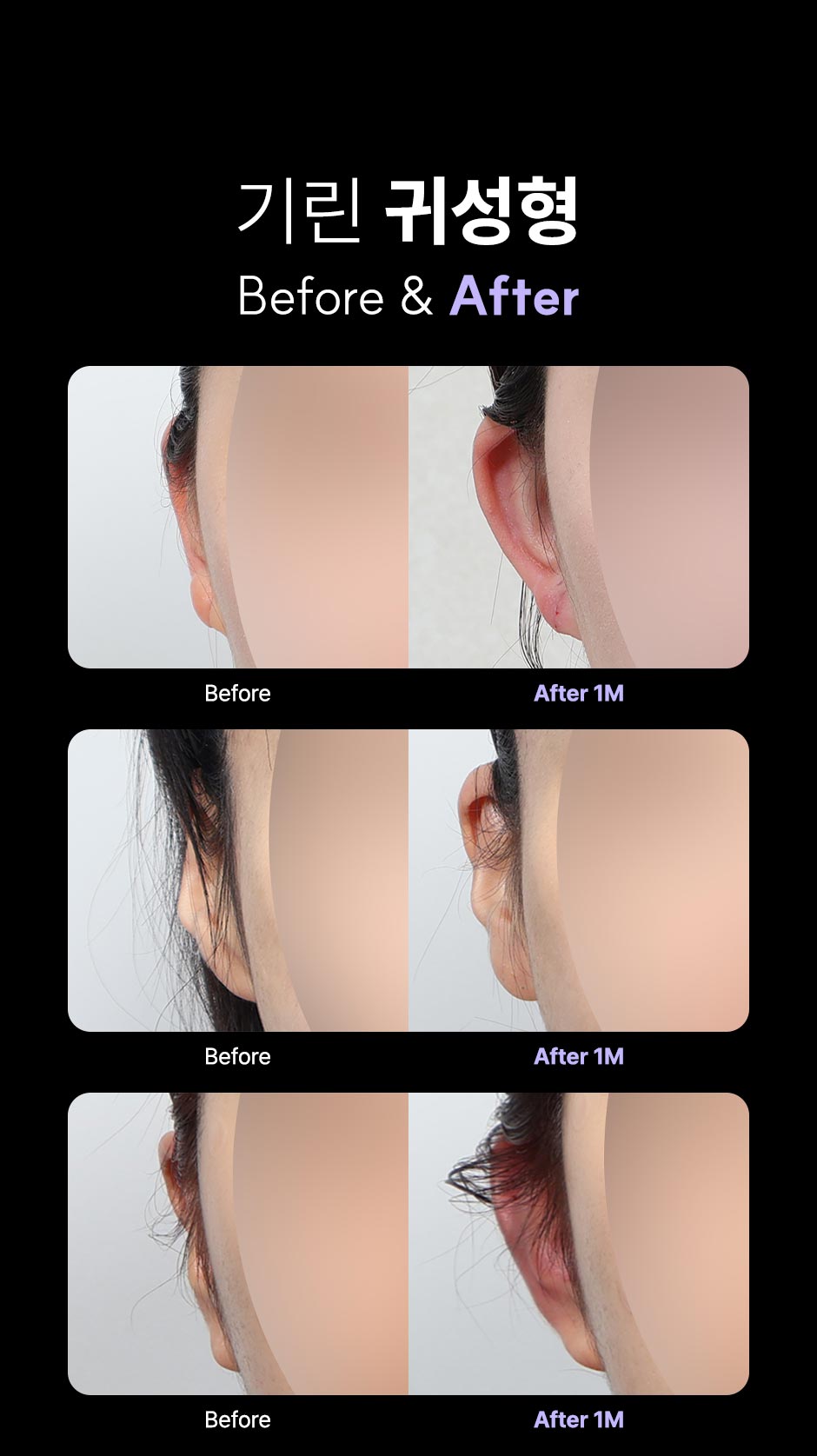 귀성형_미인하이_05.jpg