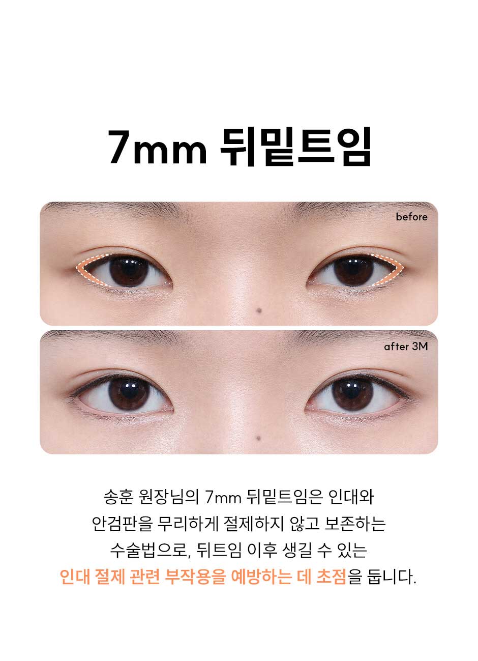 7mm뒤밑트임_미인하이_02.jpg