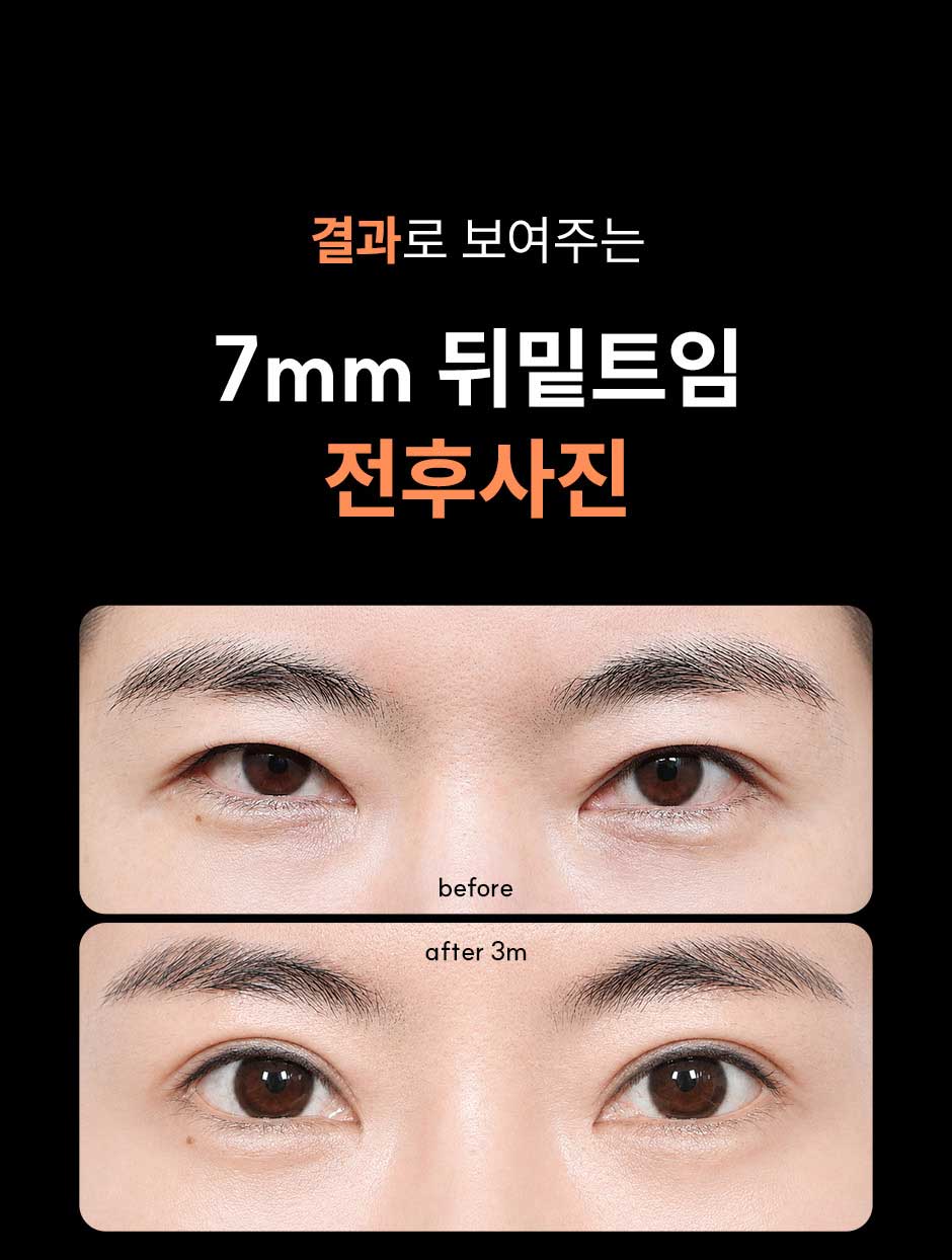 7mm뒤밑트임_미인하이_07.jpg