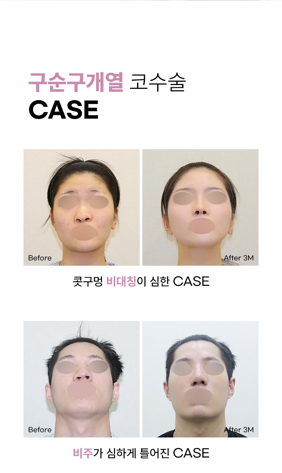 구순구개열코성형_미인하이_02.jpg