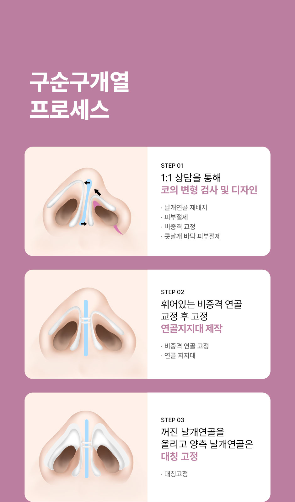 구순구개열코성형_미인하이_04.jpg