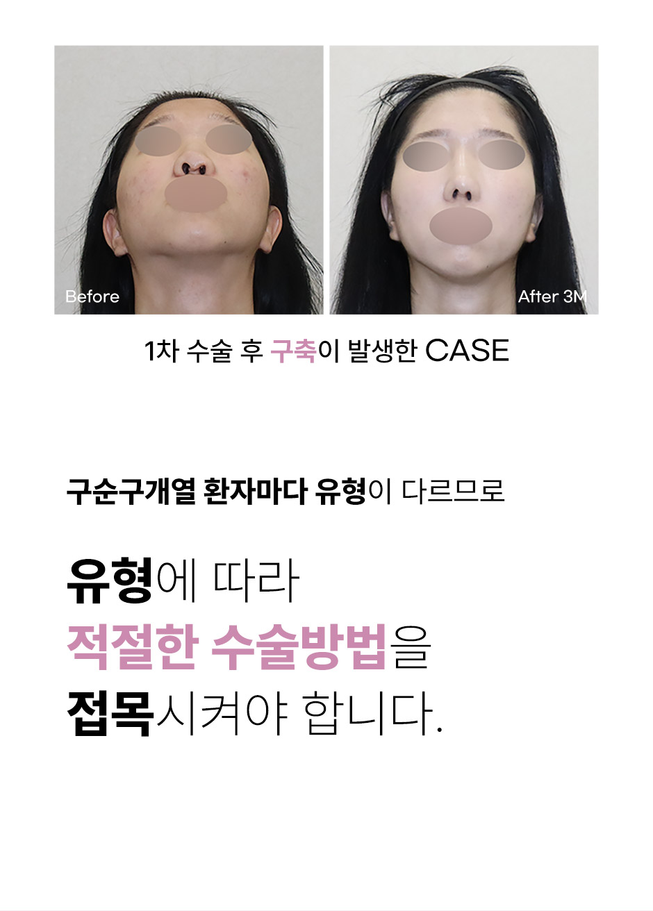 구순구개열코성형_미인하이_03.jpg