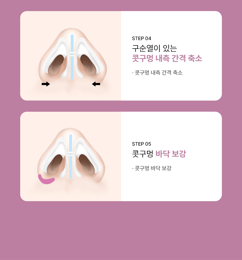 구순구개열코성형_미인하이_05.jpg