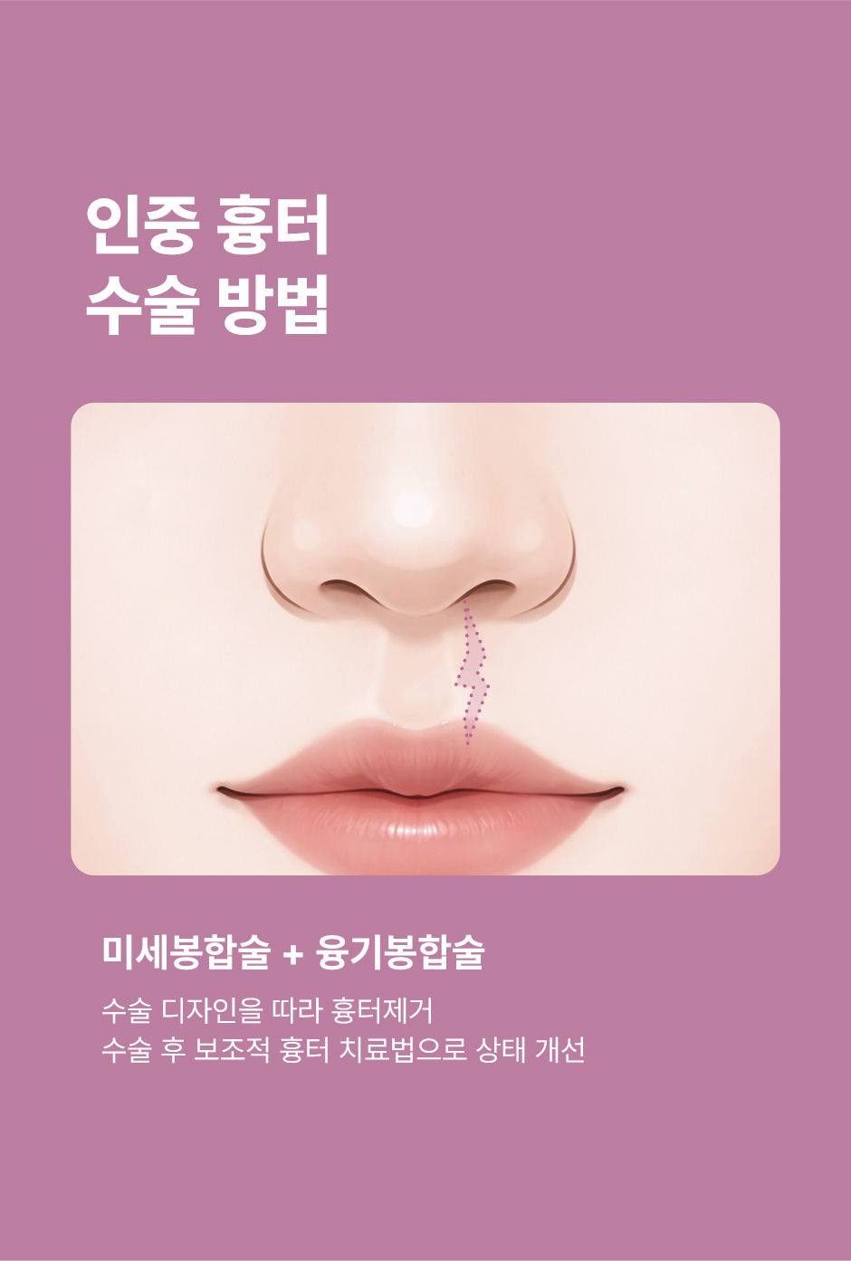 구순구개열코성형_미인하이_07.jpg