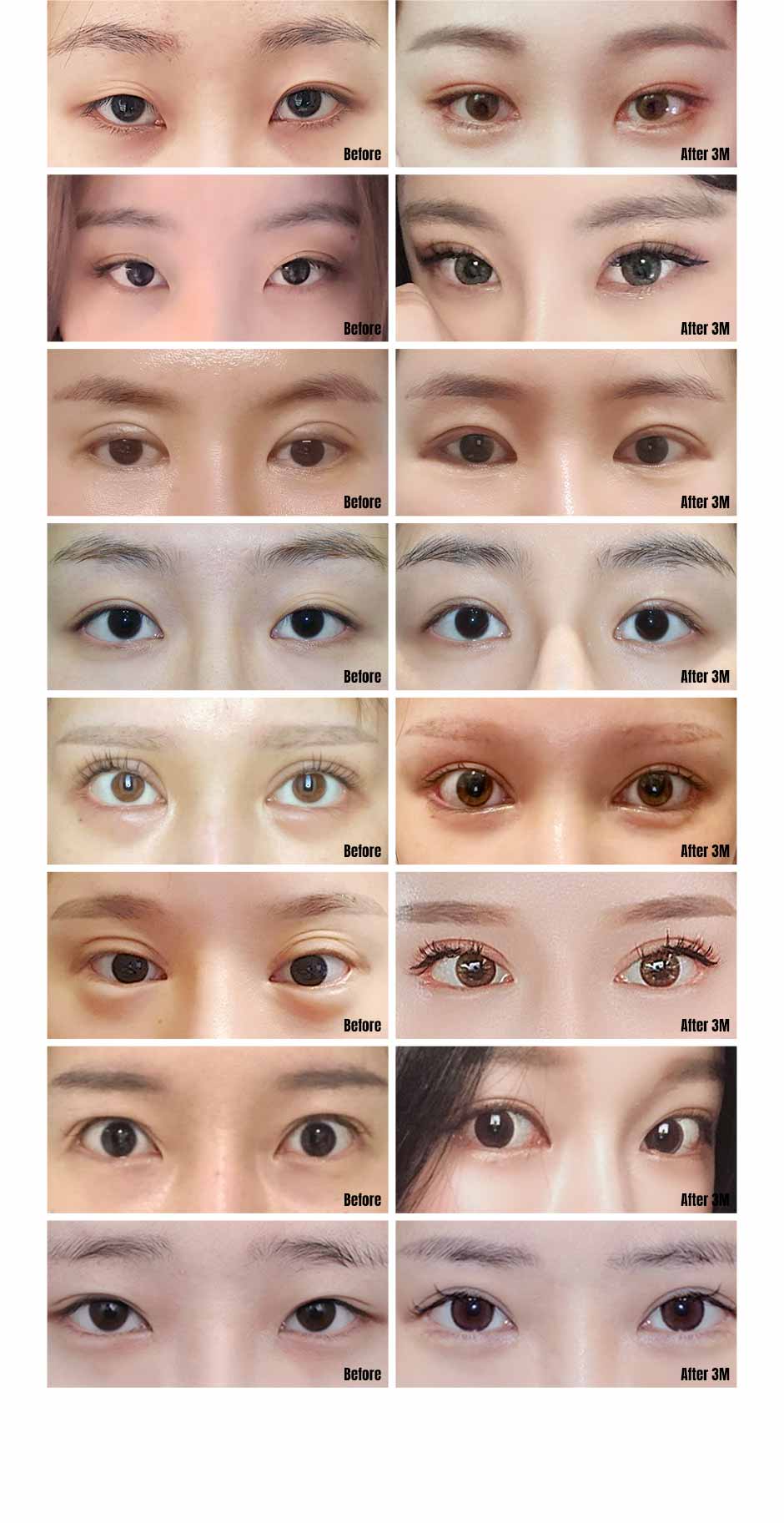 눈재수술_미인하이_04.jpg