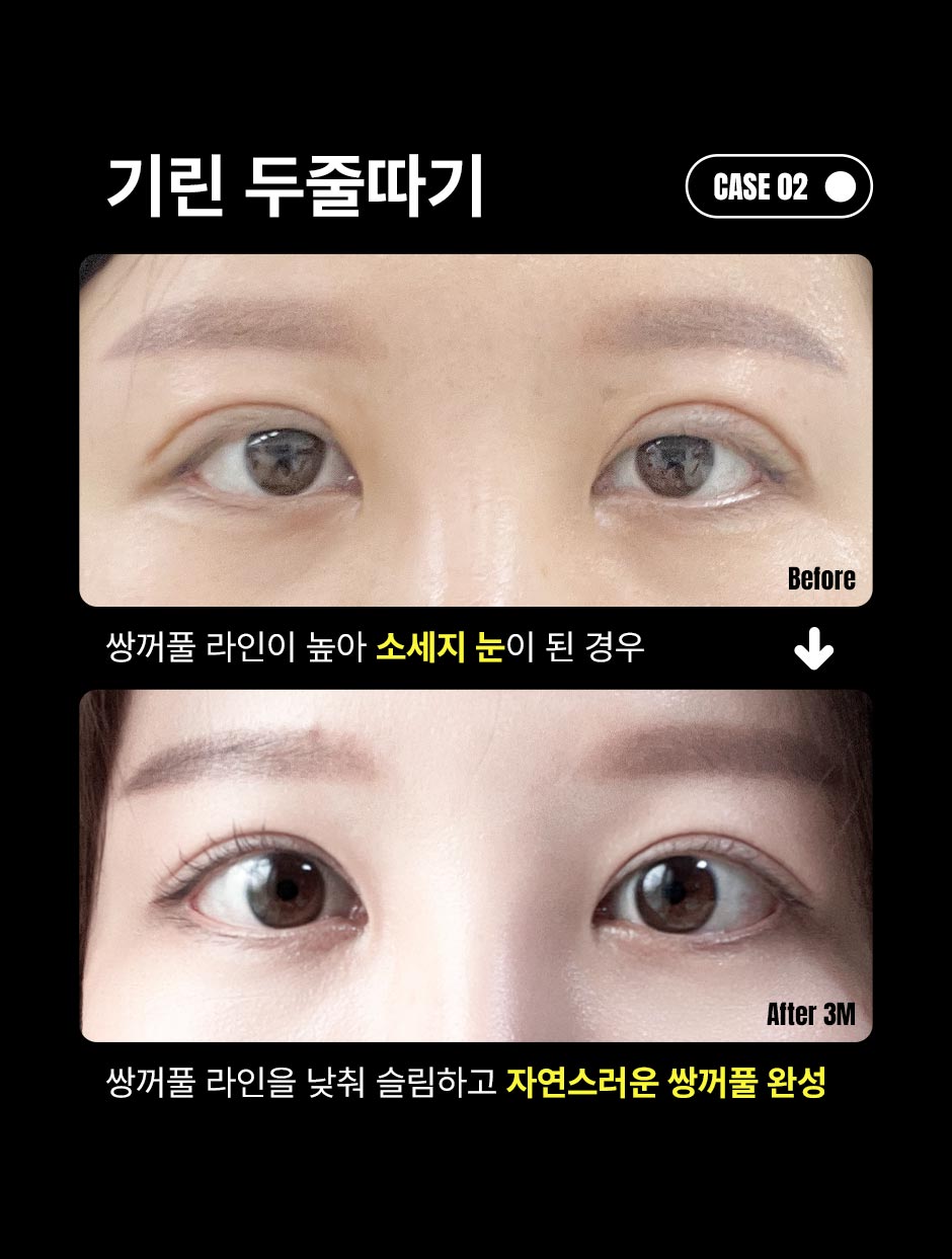 눈재수술_미인하이_06.jpg