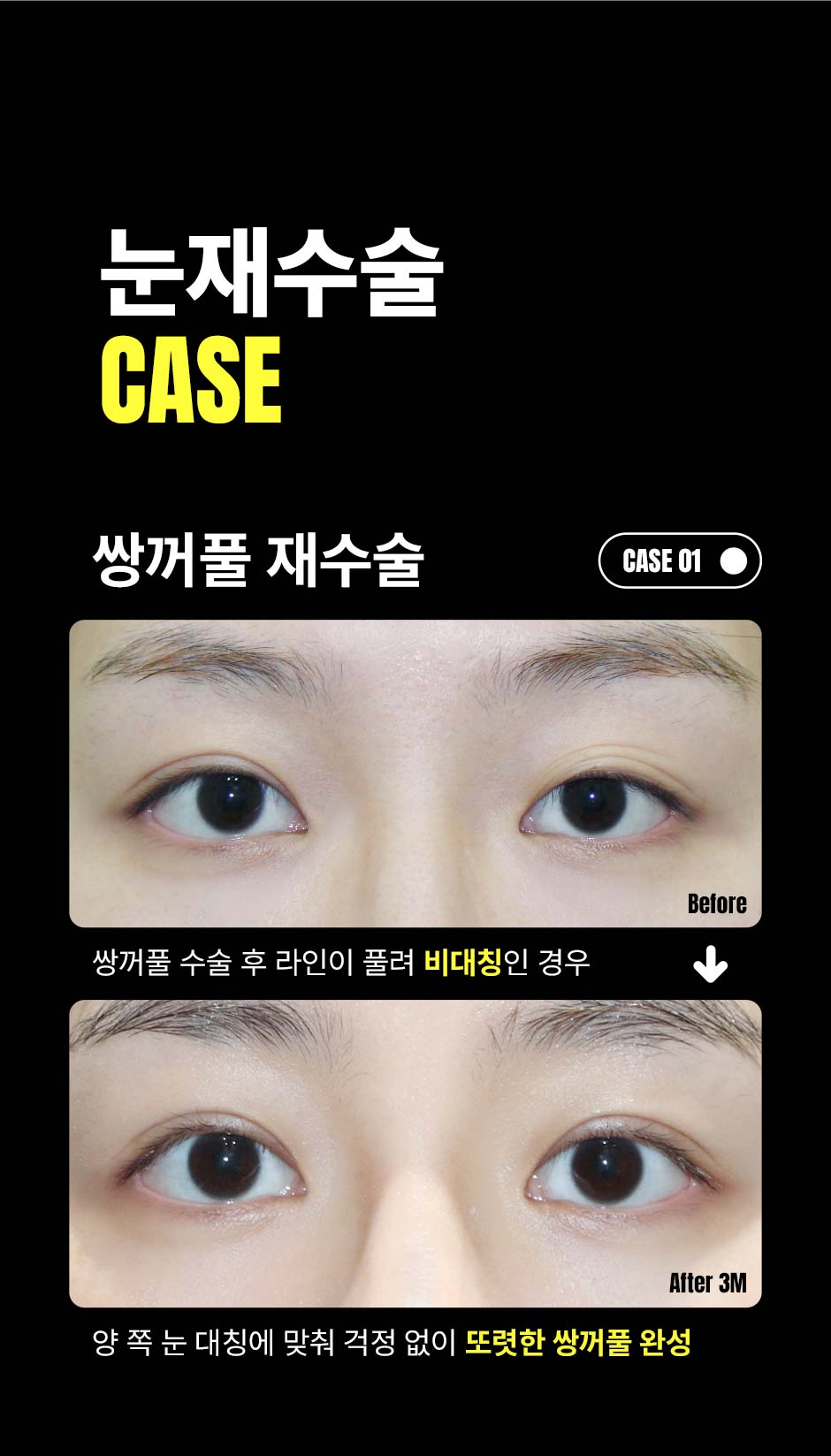 눈재수술_미인하이_05.jpg