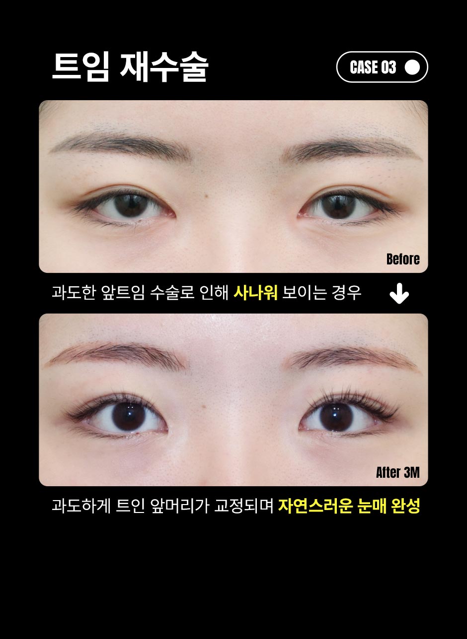 눈재수술_미인하이_07.jpg